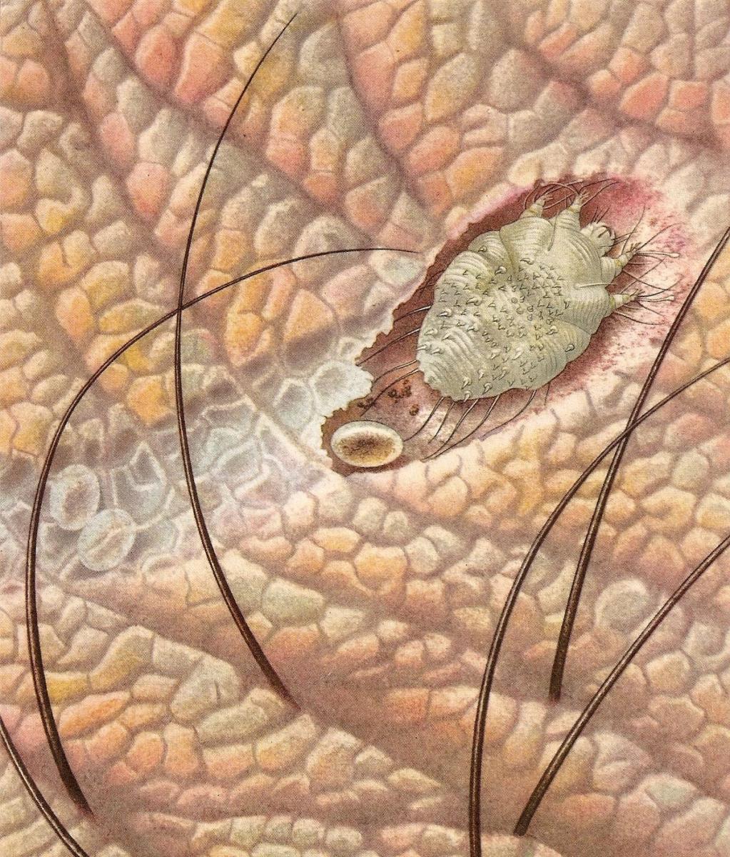 Ghẻ Sarcoptes Scabiei ăn sâu vào trong da